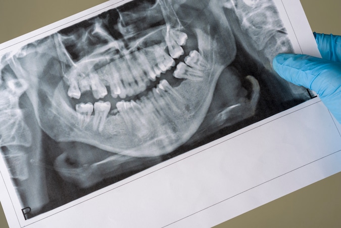 dental-insurance-for-pre-existing-conditions- -