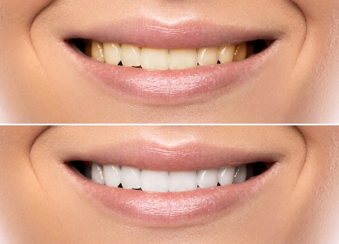 teeth-whitening-options