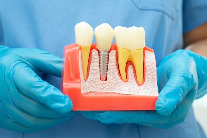 tooth-replacement-options